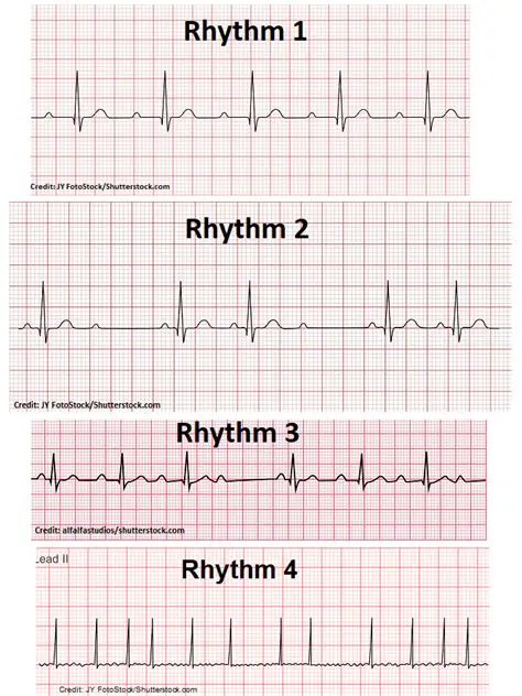Identifying the Current Cardiac Rhythm