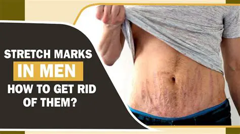 The Importance of Understanding Stretch Marks