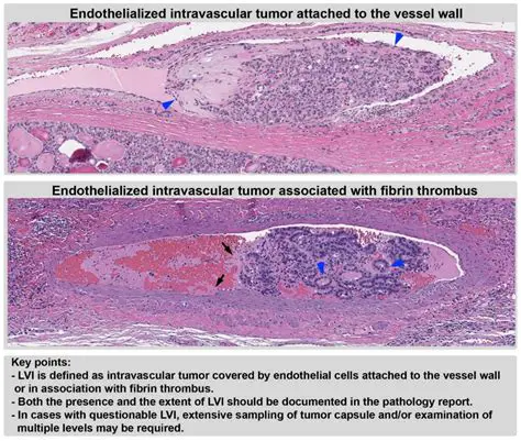 The Importance of Vascular Invasion in Colorectal Adenocarcinoma