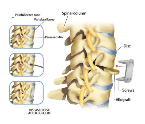 Understanding Cervical Discectomy